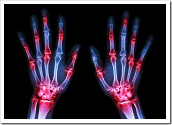Rheumatoid Arthritis Solutions Los Angeles CA